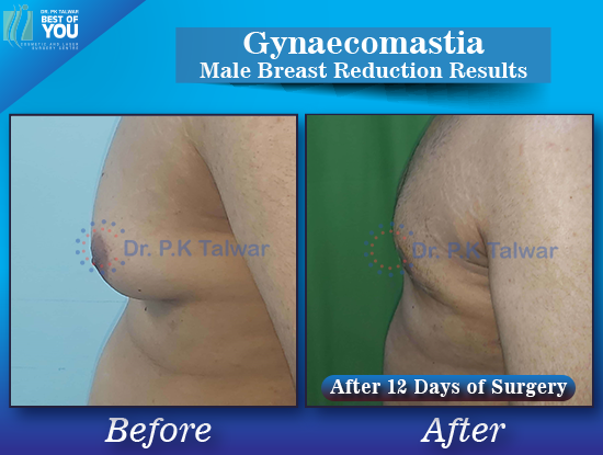 Gynaecomastia before after image